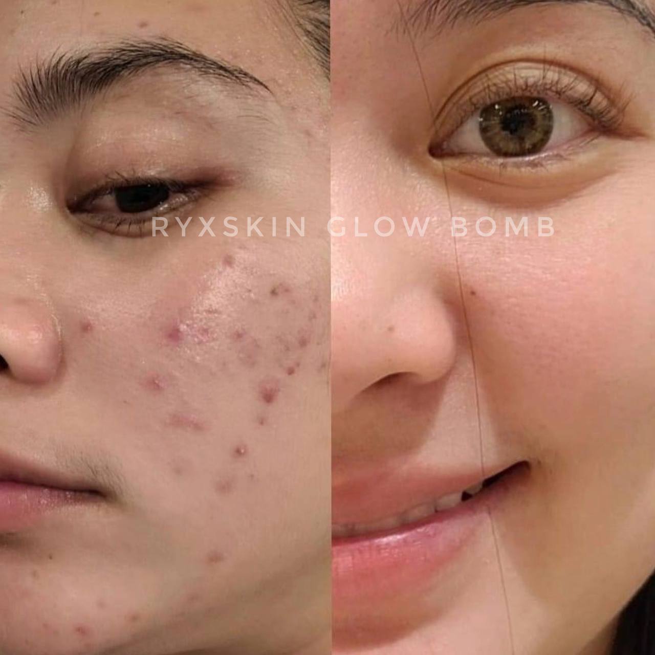 RyxSkin Glow Bomb Set